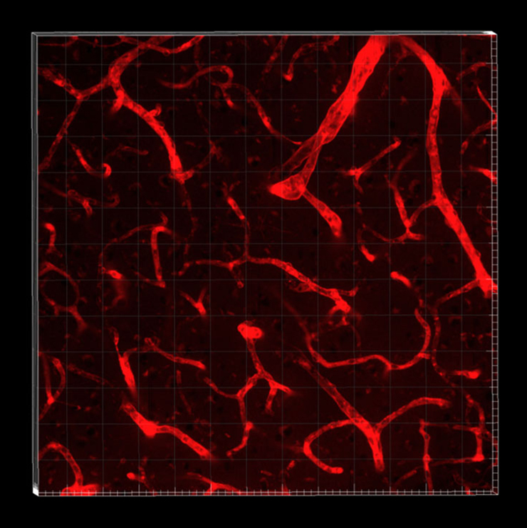 Small vessel disease